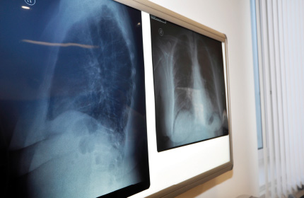 Digitale Röntgenbildaufnahme